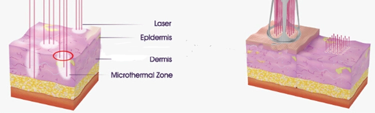 Laser Equipment CO2 Fractional Medical RF Tube Laser Machine