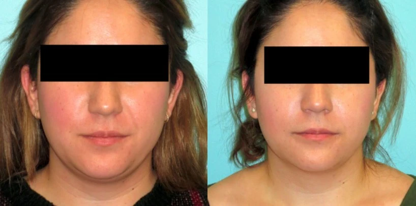 Kybella Kabelline Double Chin Fat Reduction Treatment FDA Approved Kybella Löst die darunterliegende Schicht der Fettbilder vor und nach Produkte Zur Gewichtsabnahme