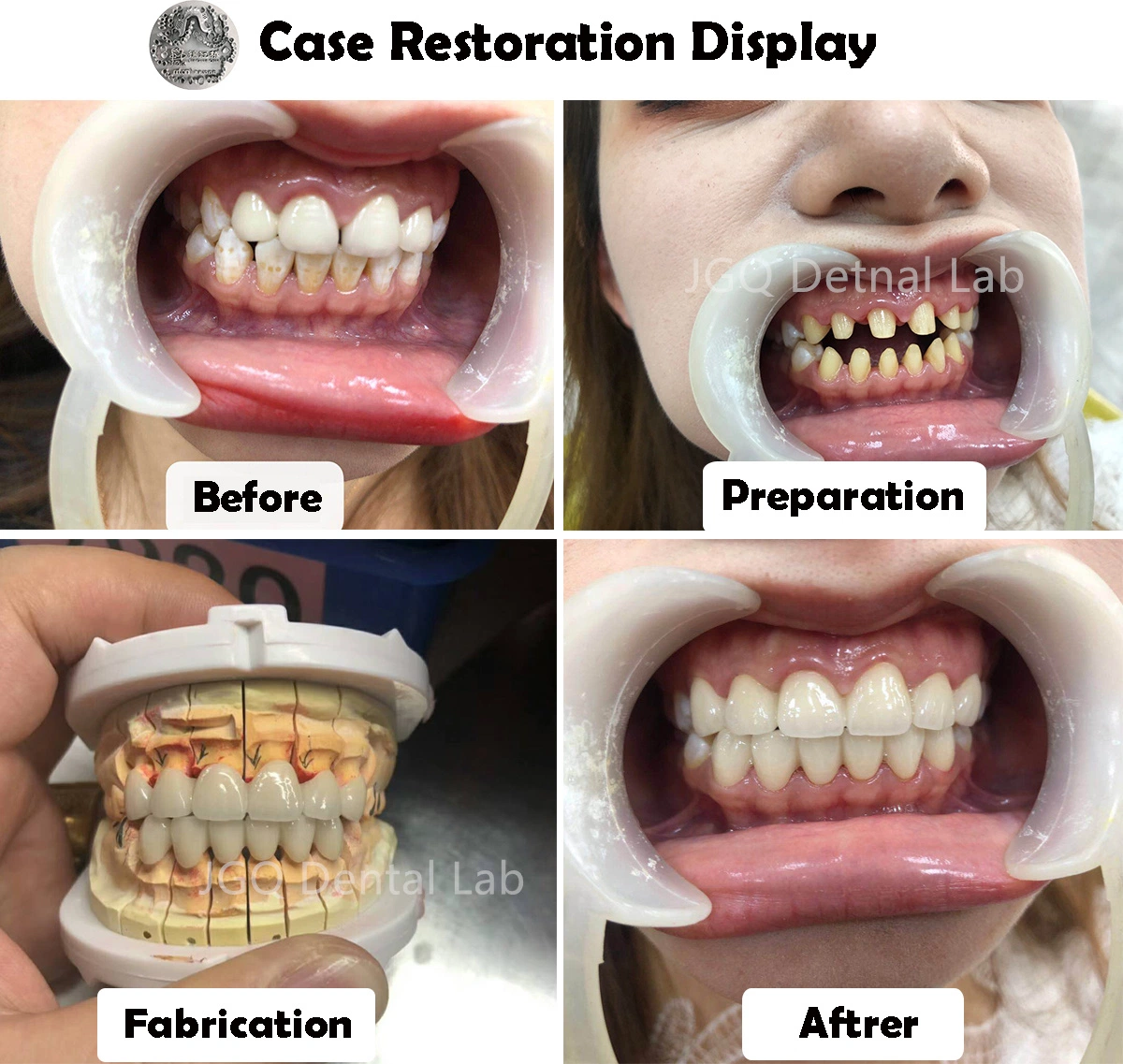 High Precise Dental Implant Tooth Full Ceramic Bridge with Pure Titanium Abutment