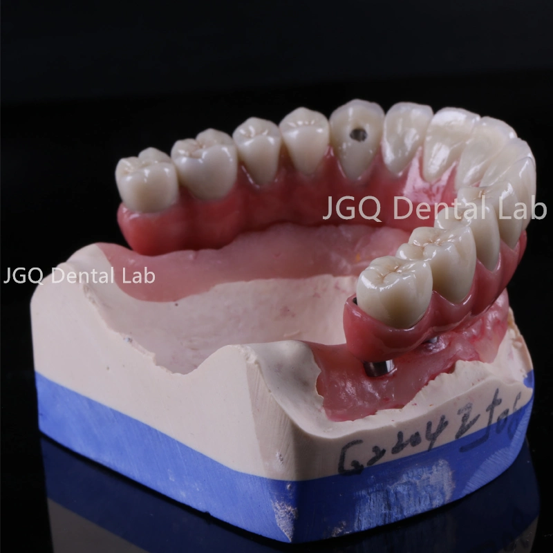 Sastre a mano Puente de Zirconia implante Dental Restauración completa Arco Alto estético