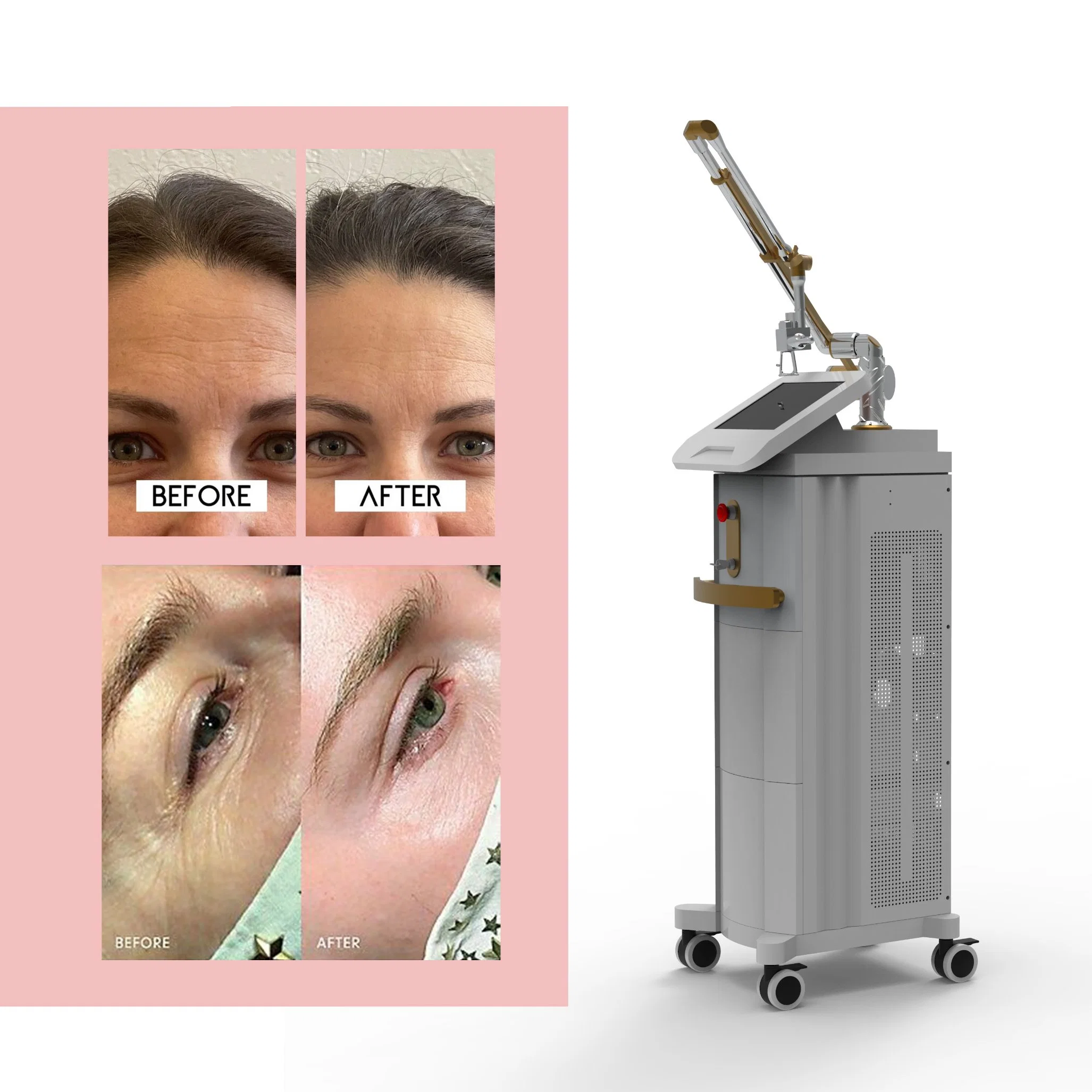 2023 Fraktionale CO2 Laser-Scar-Entfernung Vaginal Anziehmaschine / Laser Pigment Entfernung / Hautpflege Anti Aging Falten