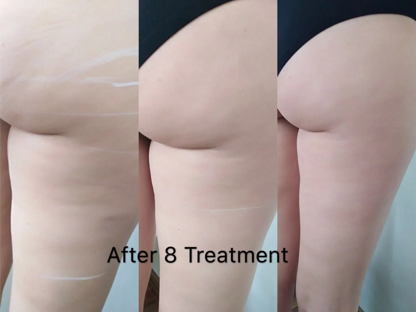 CE Certificate Effective Otesaly Weight Loss Fat Burn Injection Mesotherapy Lipo Solution Fat Loss Serum Meso Injection