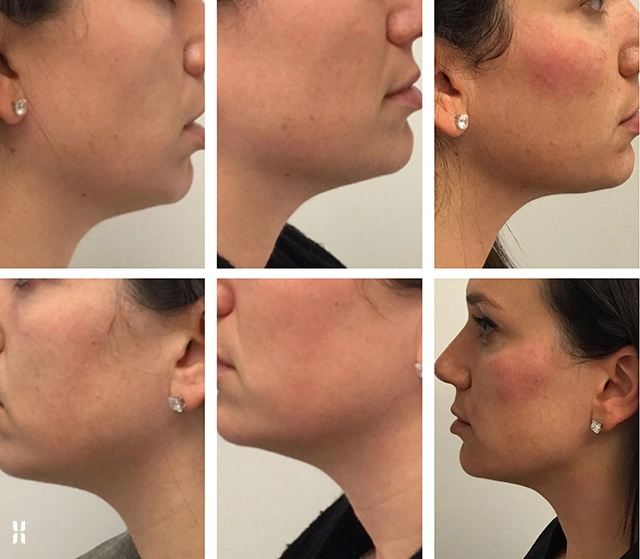 Kybella Kabelline Double Chin Fat Reduction Treatment FDA Approved Kybella Löst die darunterliegende Schicht der Fettbilder vor und nach Produkte Zur Gewichtsabnahme