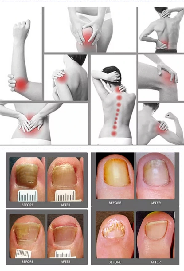 100% de retroacciones positivas 980nm Vascular Láser de Diodo de la máquina de extracción/980nm láser Máquina de belleza