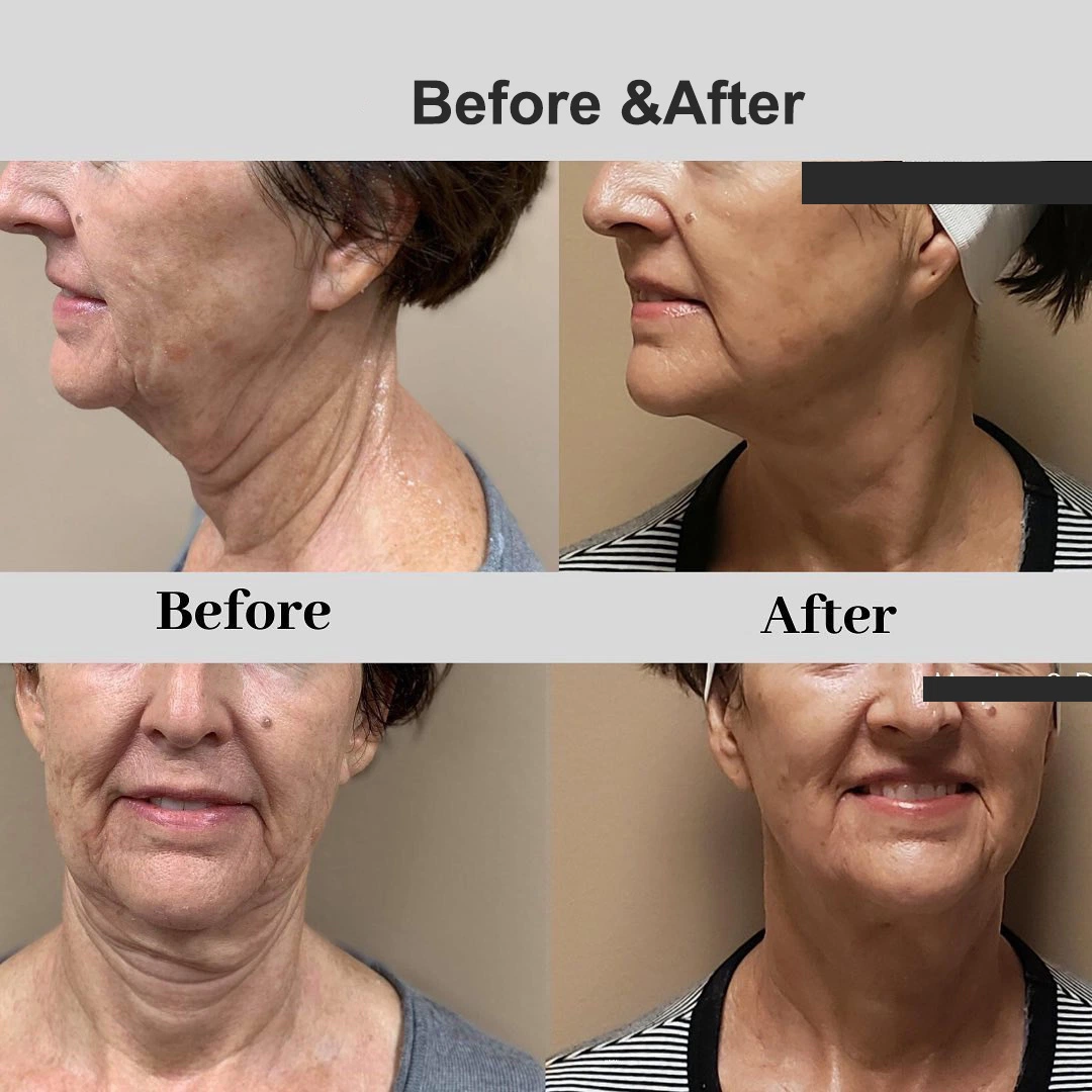 Professional Skin Tightening Radiofrecuencia Face Lift RF Microneedling RF