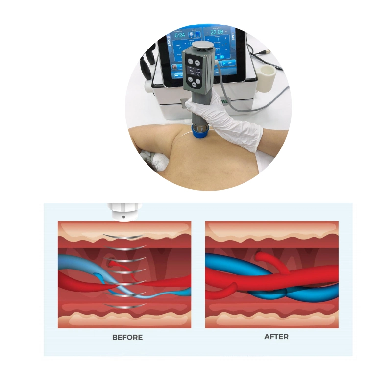 Устройство 3 в 1 EMS ударная волна, функция снятия боли Smart Tecar RET CET Therapy Shockwave Machine ED Treatment (Процедура облучения КД с помощью аппарата RET