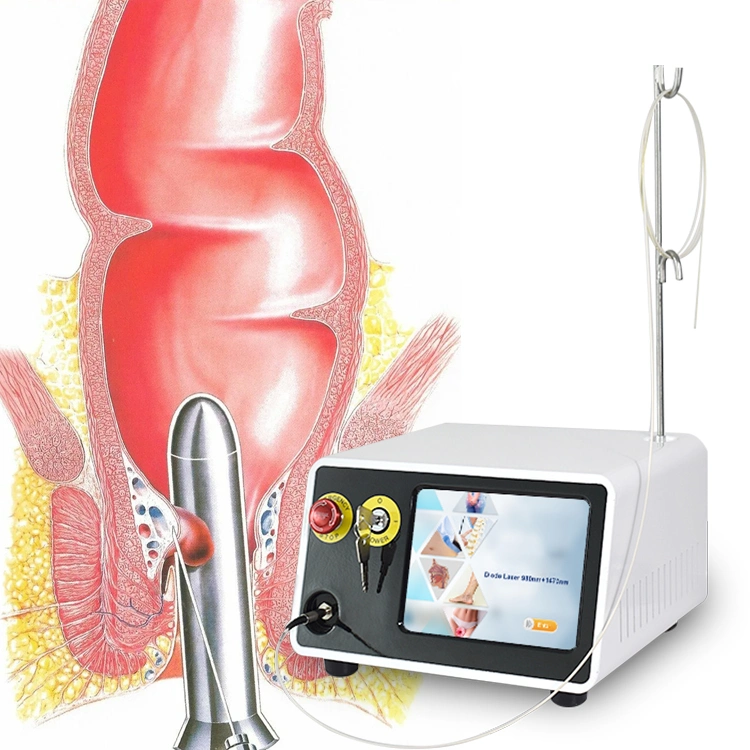 Hemorrhoidectomy Medical Surgery Laser 980nm 1470nm Hemorrhoids Treatment Surgery Anal Fistula Device