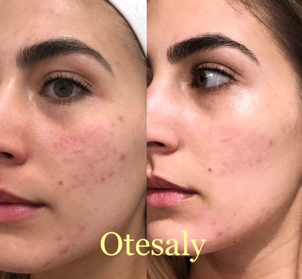 Otesaly Revitalization Injection Racemic Glutathione Product Skin Rejuvenation Solution Used to Reduce Skin Pigmentation 5ml Bottle