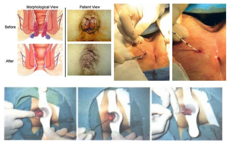 980nm 1470nm pilas de hemorroides fístula ablación con láser Proctología Anorrectal con láser Láser de hemorroides en Proctología tratamiento de hemorroides con láser quirúrgico anorrectal