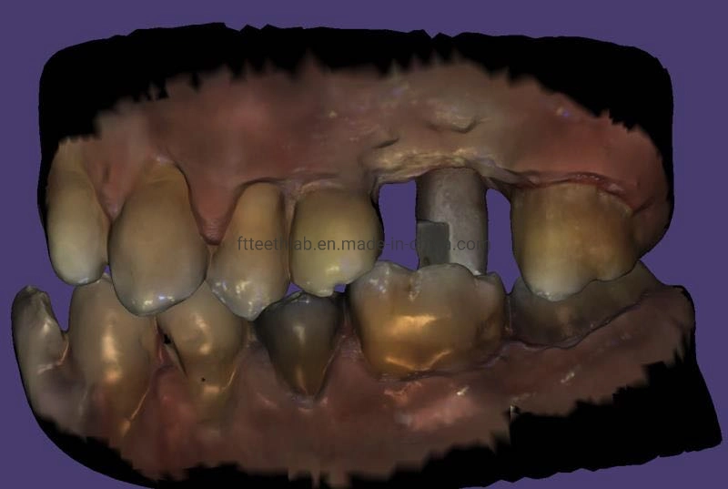 Цифровой имплантат случаев с цифровых файлов сканирования зубных имплантатов