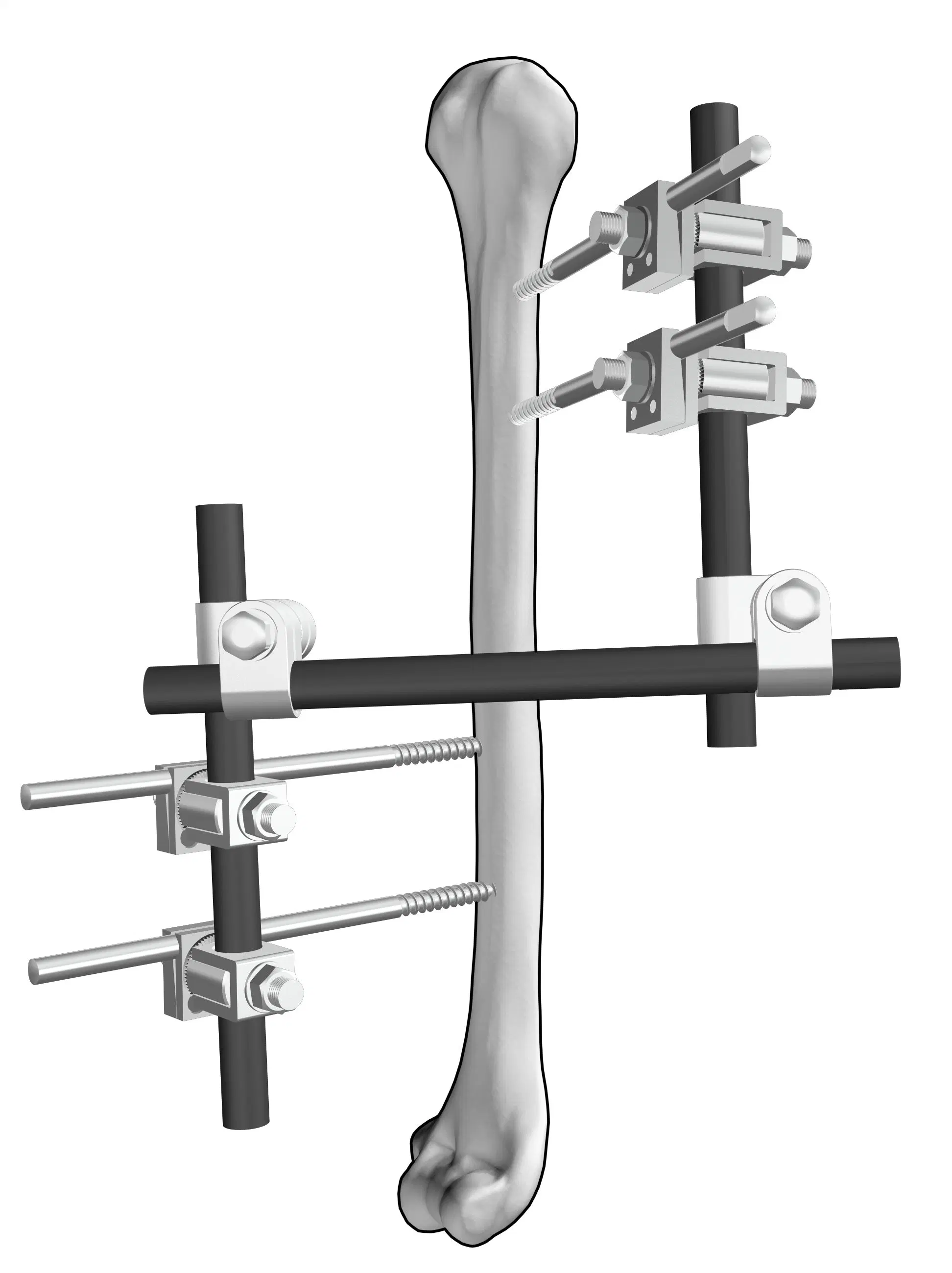 Sistema de fijación externa ortopédico de la disección II húmero la fijación externa