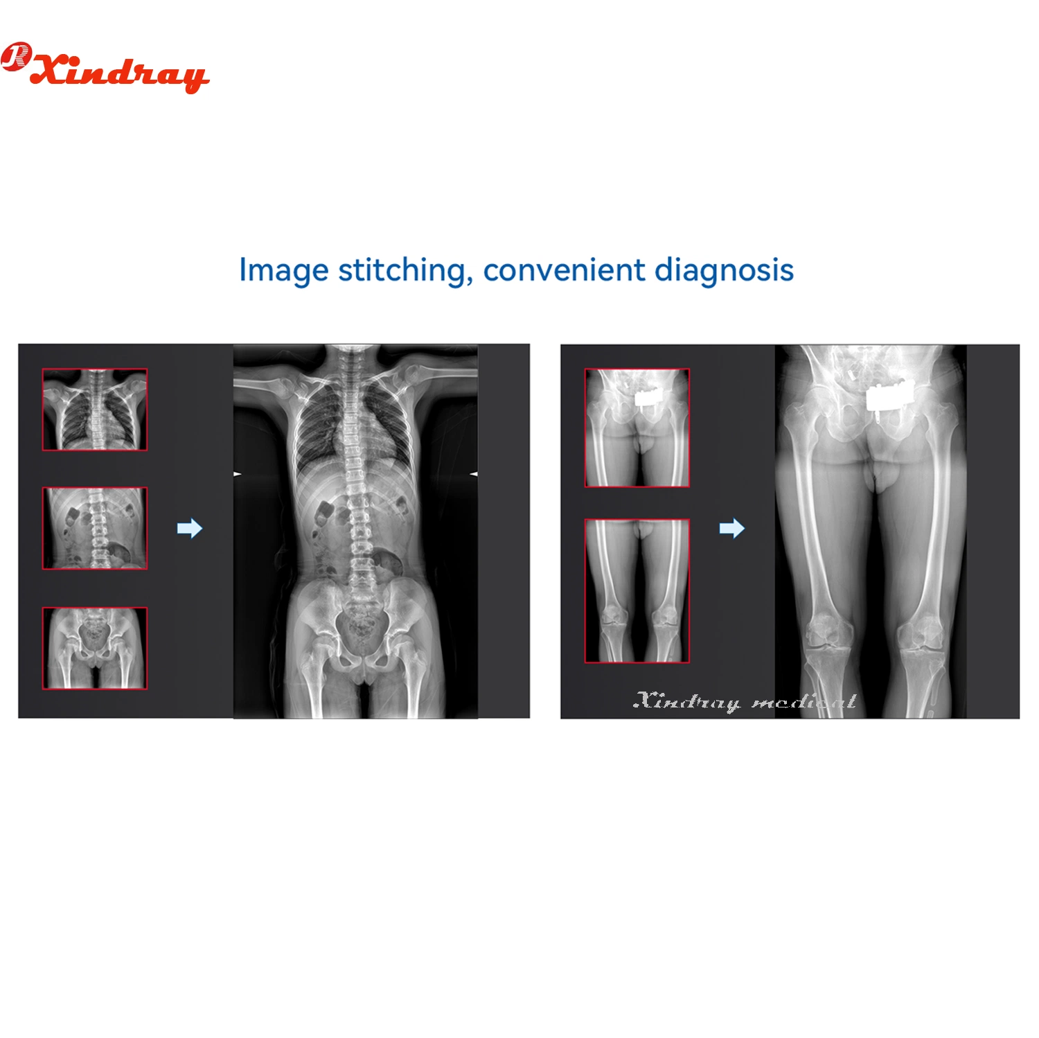 Factory Price Hospital Medical Equipment High Frequency Toshiba Siemens X-ray Трубка 200 мА 500 мА 630 мА 32 кВт 50 квт стационарный цифровой рентгеновский аппарат Медицинская рентгеновская установка