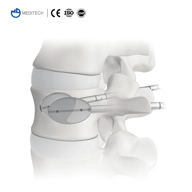 High quality/High cost performance  Percutaneous Access Device Thoracic Layer by Layer Puncture Pvp Guide Needle Vertebral Perforator Kit