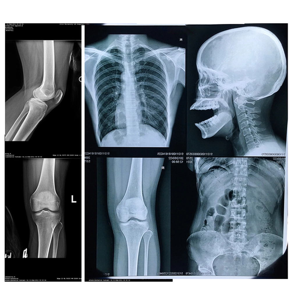 Fábrica Precio mayorista Imágenes de rayos X película de impresión impermeable mascota médica Película de rayos X de inyección de tinta térmica seca con base azul