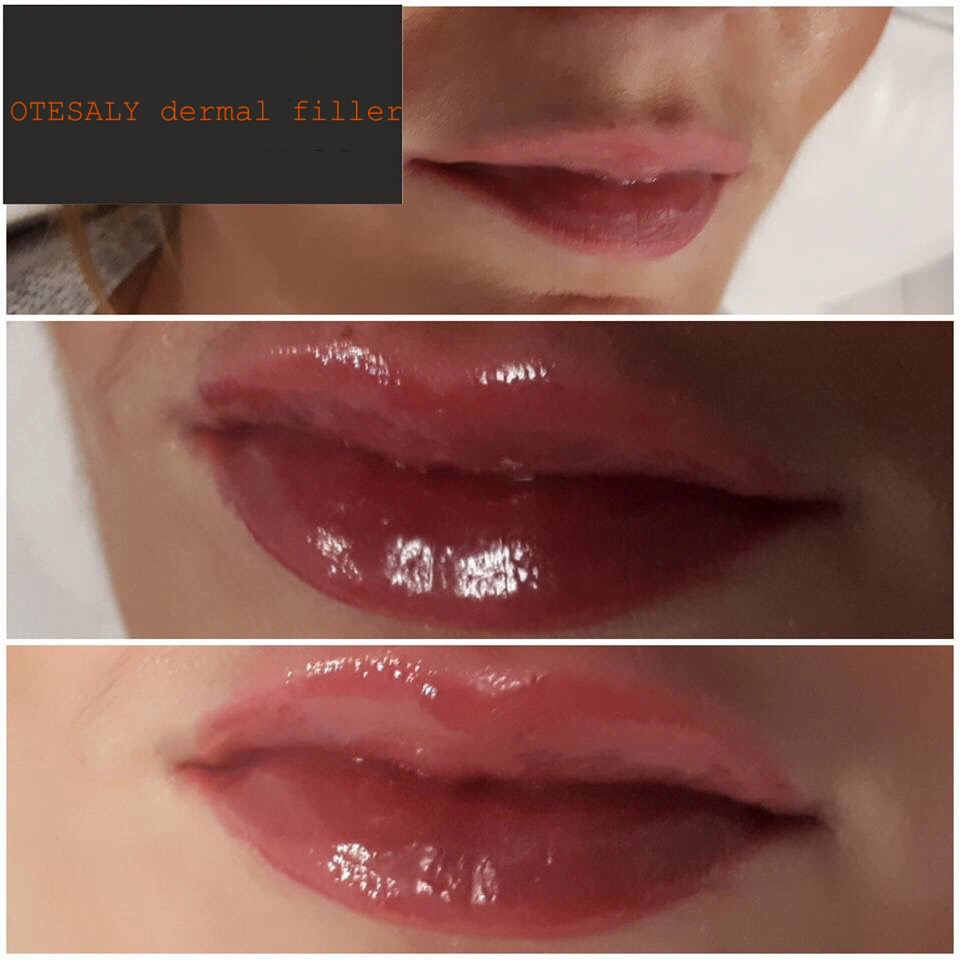 شهادة CE عبر الحدود Ha Dermal Filler Lido Injection Ha حشو ليدو من النحت لحقن النحت مع ليدو بنسبة 3%