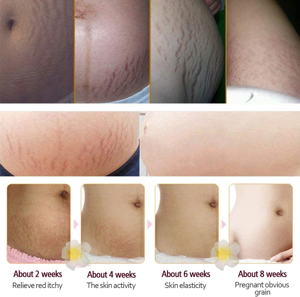 Wholesale/Supplier Scar Post-Natal Repair and Anti-Obesity Growth Lines and Pregnancy Lines Repair Cream