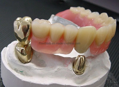 Telescópio removível dentaduras parcial fundido metal fabricado na China Laboratório de medicina dentária