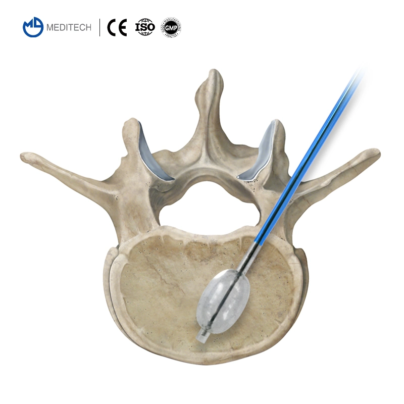 High quality/High cost performance  Percutaneous Access Device Thoracic Layer by Layer Puncture Pvp Guide Needle Vertebral Perforator Kit