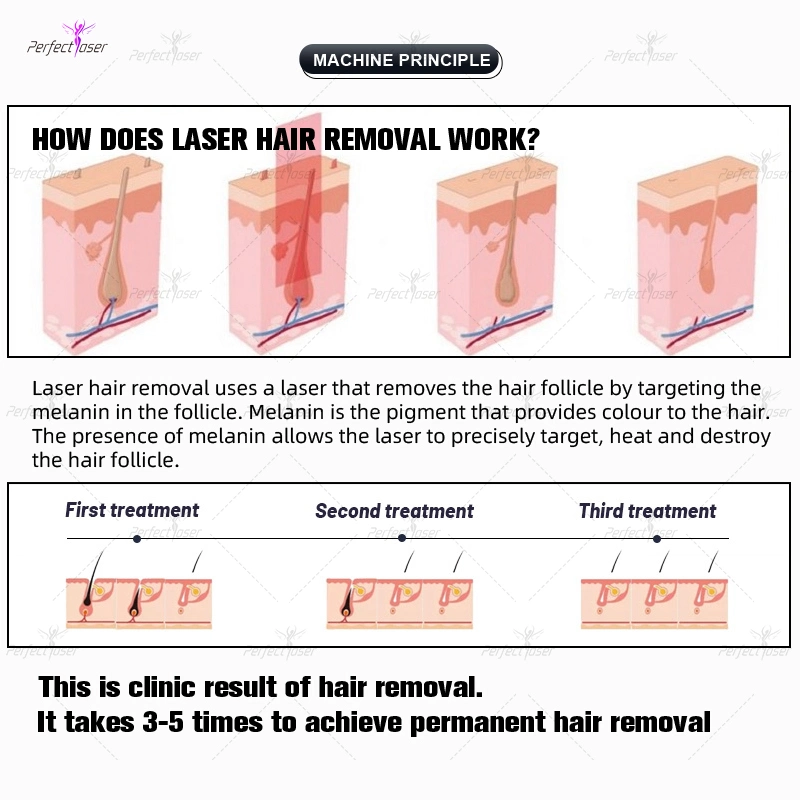 CE/FDA/RoHS todos los tipos de piel de la máquina de Depilación Láser de Diodo de equipos de belleza inicio