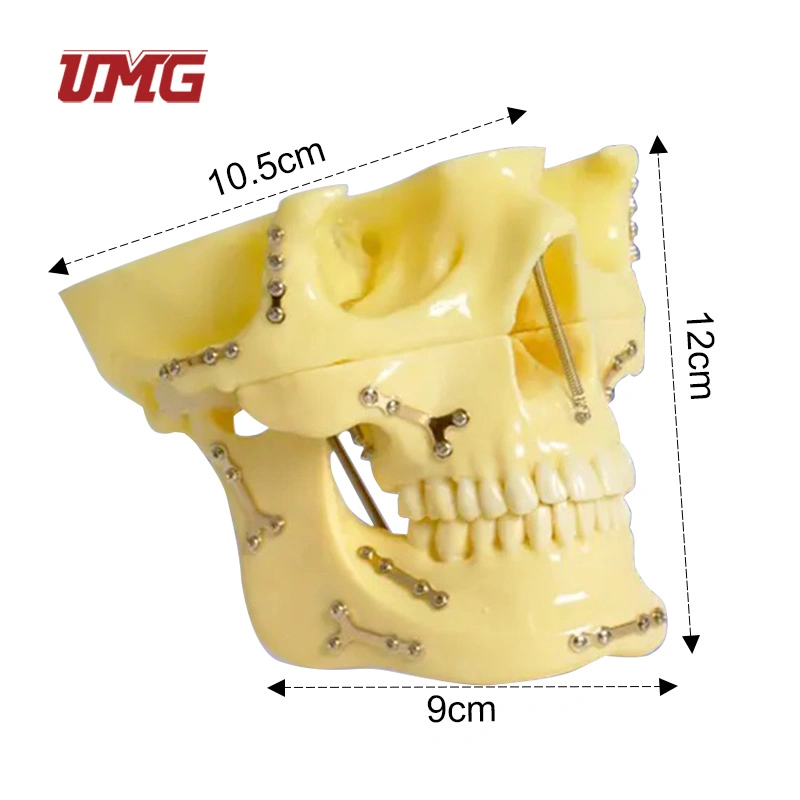 Fixed Bone Fracture with Titanium Plate and Ortho Implant Dental Skull Model