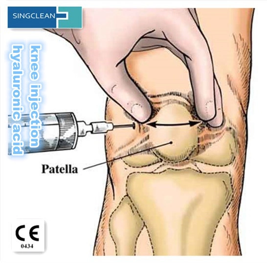 Singjoint Quickclean Ha Medical Sodium Hyaluronate Gel for Orthopedics Surgery Injection