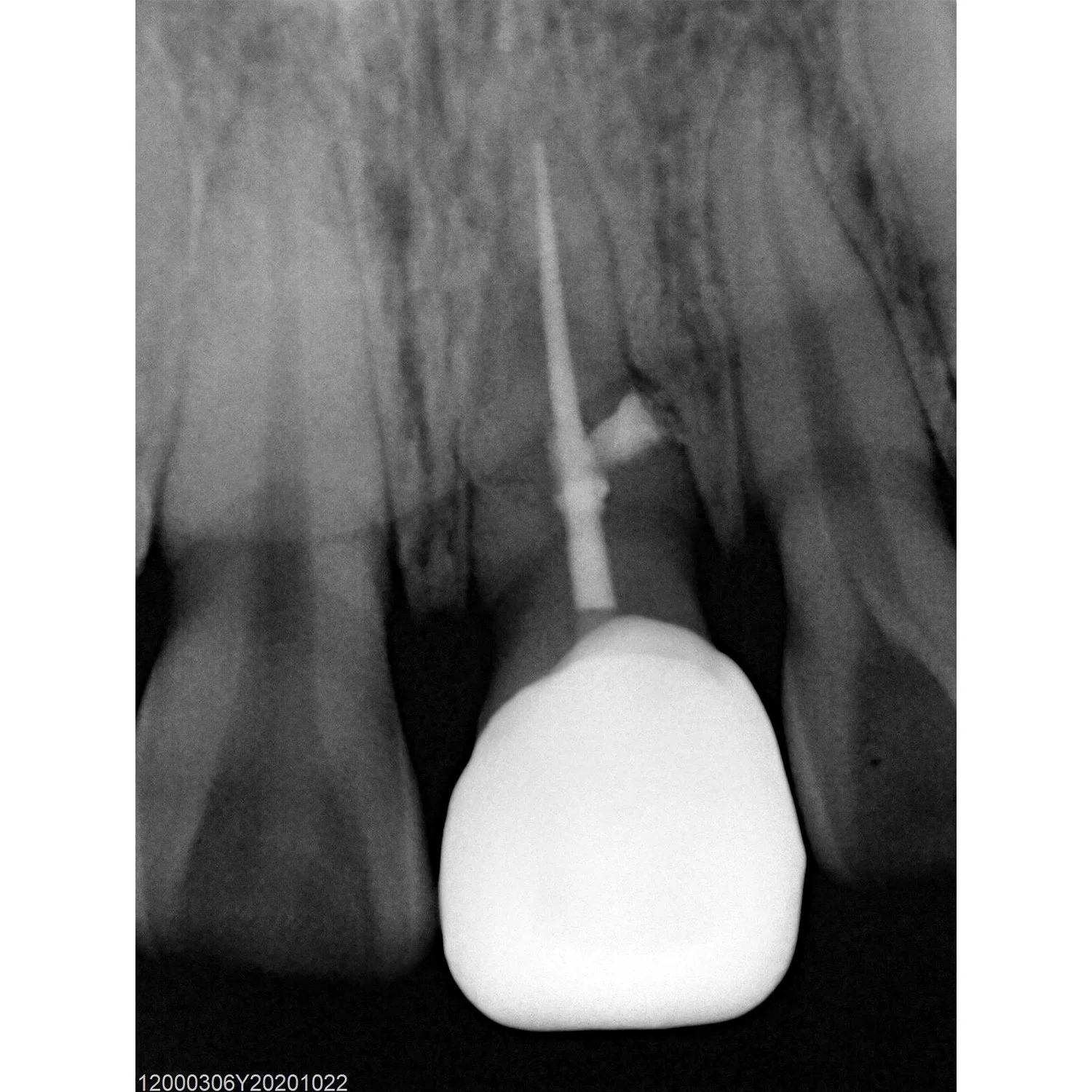 Sensor Digital Dental Rvg, Sensor de Raio-X Dentário USB de Boa Imagem Ruyes