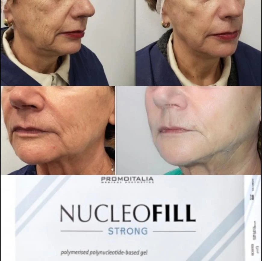 Nucleofill Strong Pn 2.5% Seven Point Antioxidant Hydrating Skin Regeneration Filler 1.5ml