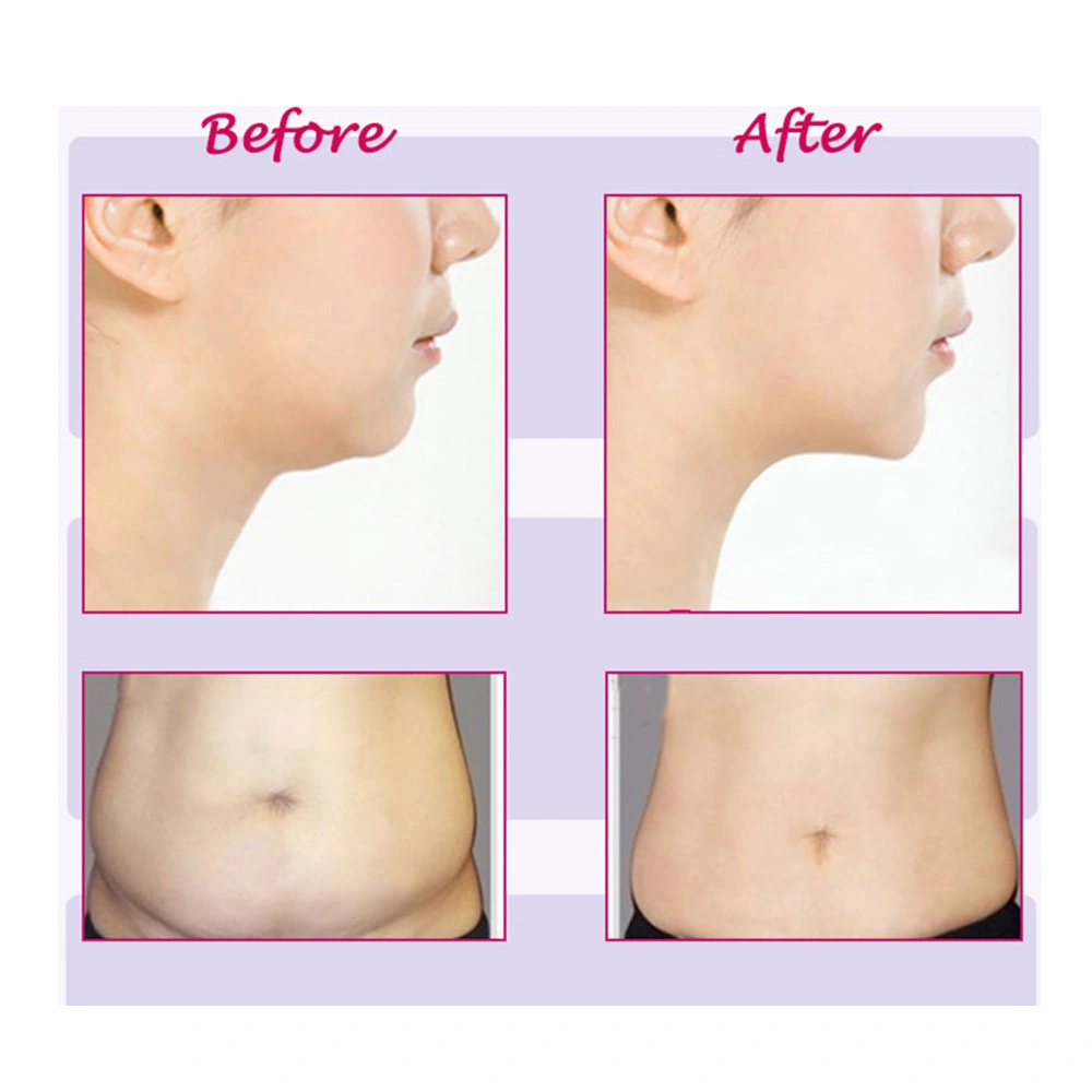 Korea Lipo Lab White Lipolytic Solution Mesotherapy Deoxycholic Acid for Fat Loss Dissolve