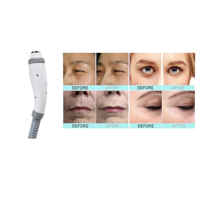 4 em 1 Máquina de beleza RF laser 808nm + Laser de diodo laser YAG ND de remoção de tatuagens + Remoção de pêlos Dpl