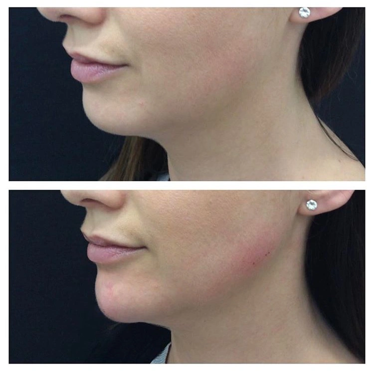 Top Rated CE Approved Cross Linked Jealifill 1ml Deep Nose Shaping Cheek Augmentation Hyaluronic Acid Dermal Filler