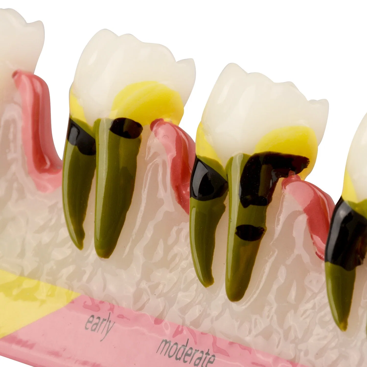 Dental Periodontal Disease Assort Model