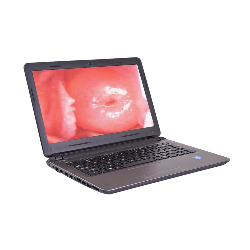 Ginecología portátil Colposcopy dispositivo Digital Video Colposcopio para la vulva del cuello uterino Vagina