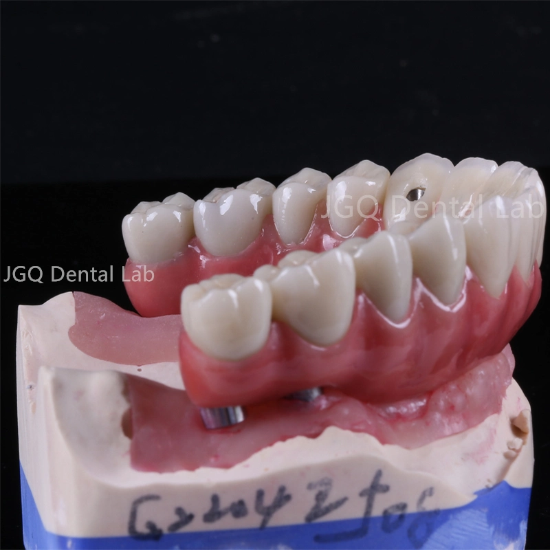 Implante dental Personalice Super estructura All-on-6 contorno completo Zirconia Dental Puente de implante