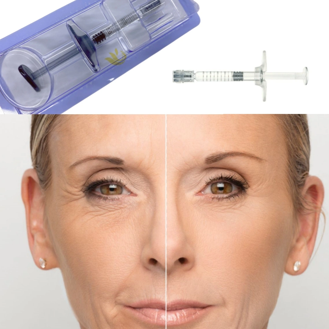 Hyaluronsäure Gel Injectable Dermal Filler für die Gesichtspflege