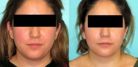 Super Slim la pérdida de peso fácil y mejor Max Belkyra naturales adelgazantes o Kybella Papada Kabelline inyectables Nuevo tratamiento para la papada producto de la pérdida de peso