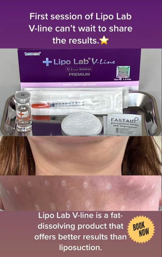 2020 مختبر Lipo Vline جديد ، سلامة عالية ، تأثير سريع ، تأثيرات جانبية صغيرة ، تشكيل سريع للحقن لحل حل الدهون خط الفك