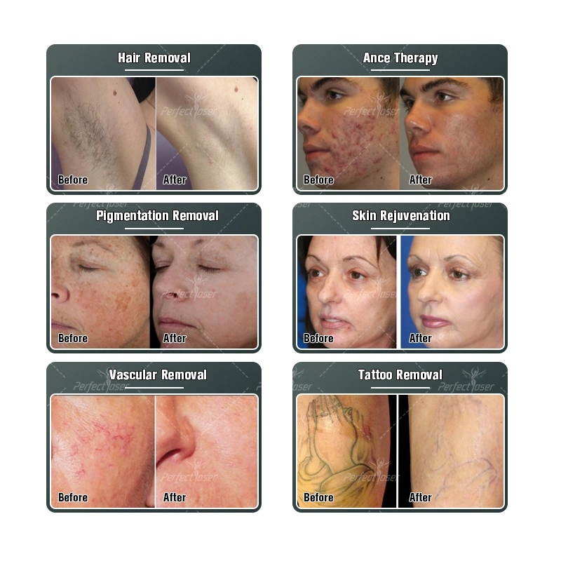 Technologies multiples Fast Cooling Hair Removal pigmentation anti-âge Beauté Équipement