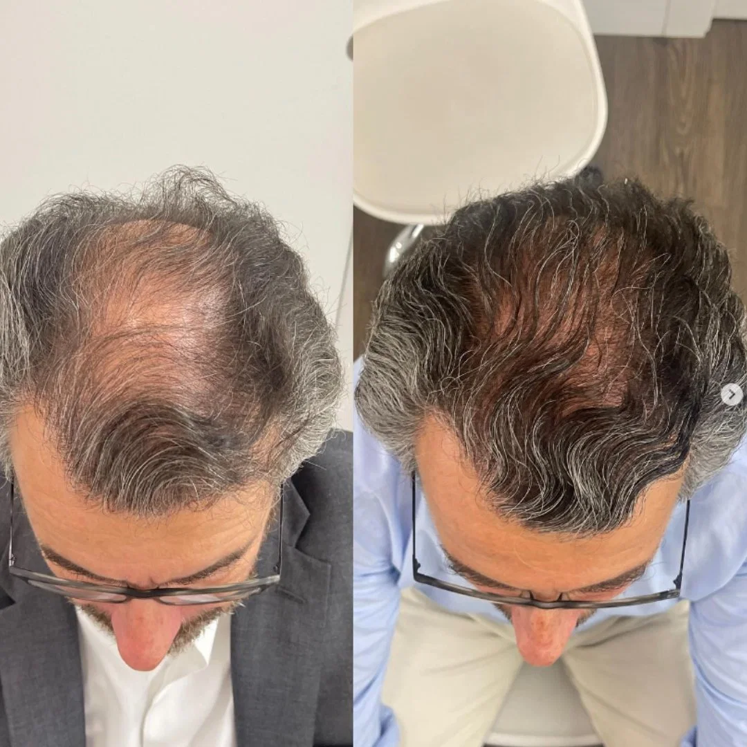 Anti Haarausfall Pflege Behandlung Aape Scm Haircare Booster Effizient Haarwachstum Stammzellen Frauen Männer Nachwachsen Faktoren für Haarausfall Prävention Hair-Repai Asce Hrlv