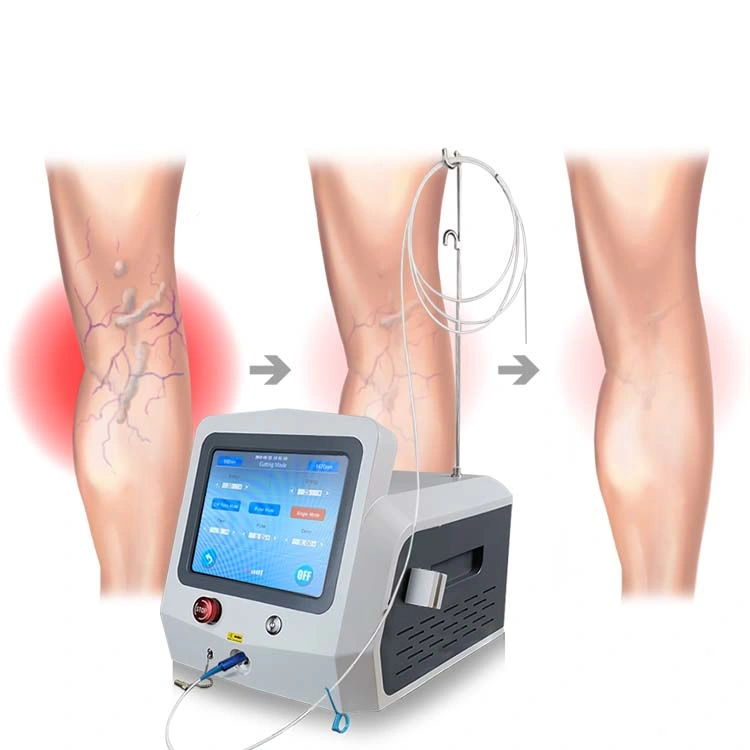 1470nm Evlt Cirugía Láser de Vena Varicosa para Fotos de Venas Varicosas Cura de Venas Láser de Diodo 980 Nm Ablación Láser de Vena Varicosa