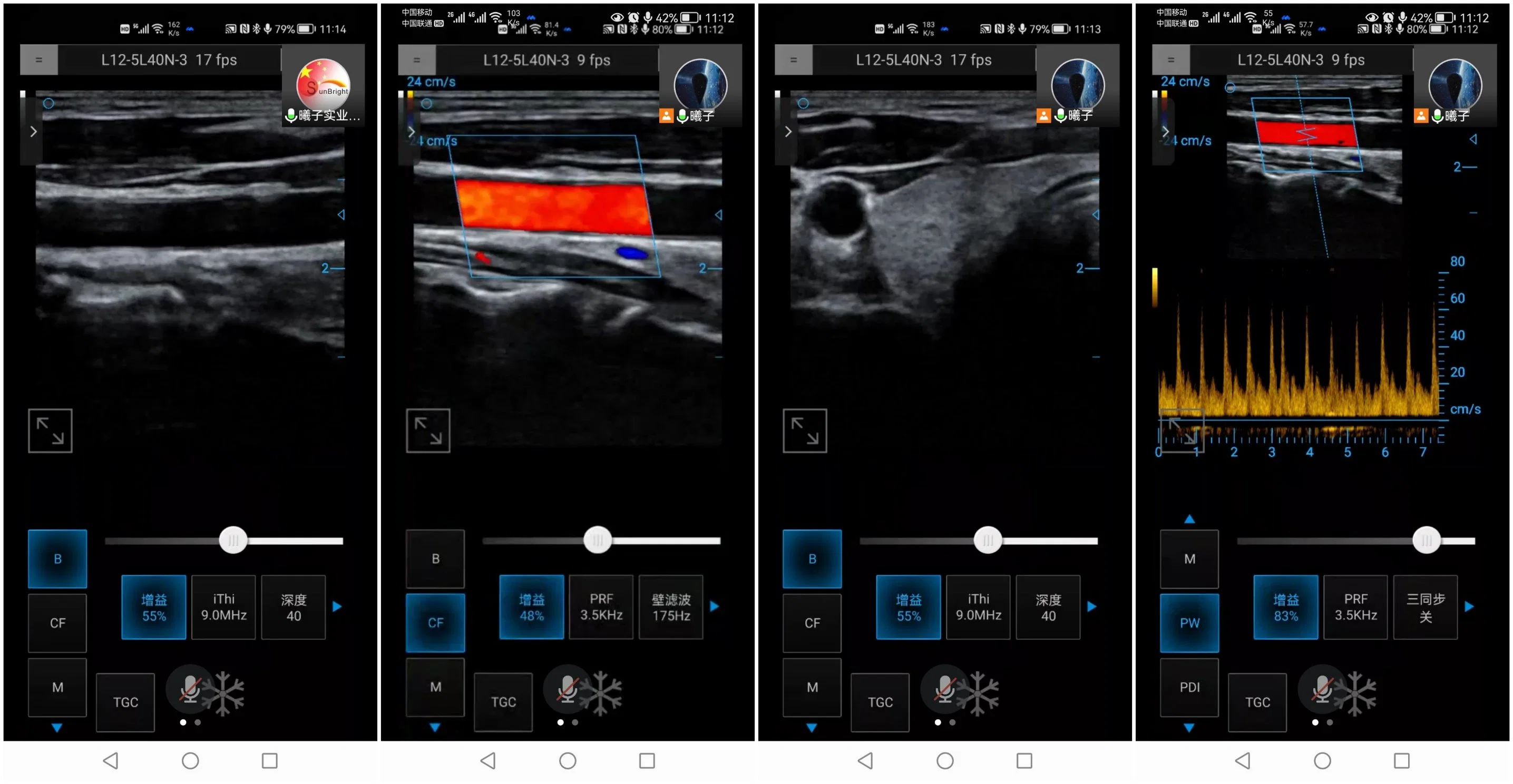 Escáner Doppler de color portátil Tamaño de bolsillo Ultrasonido Doppler para Windows/Android