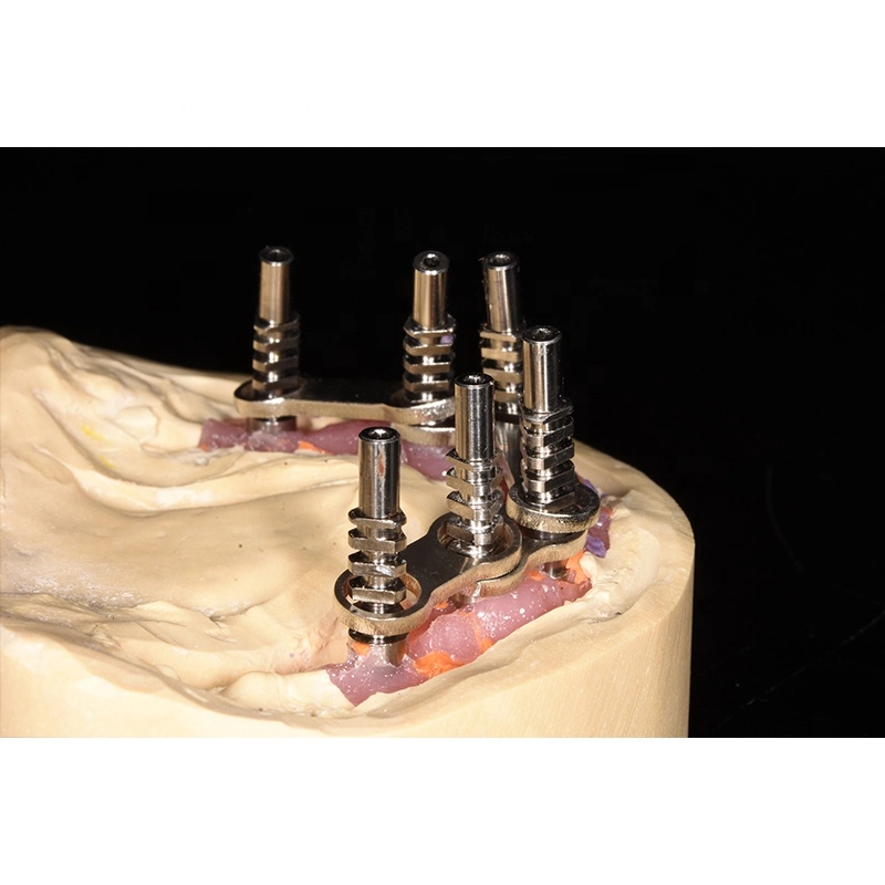 All on 4 Dental Prosthesis Metal Implant Supported Overdenture Bar