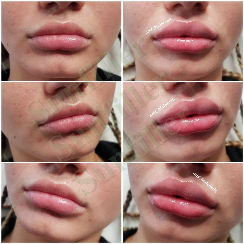 Lip Implant Cross Linked Ha Lip Injection Hyaluronic Acid Filler