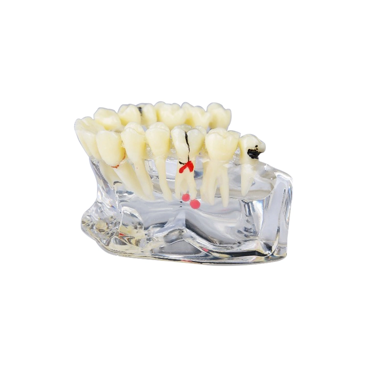 Implant Model for Showing Implant and Restoration Caries