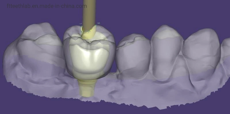 Dental Implant Bridge Made with Digital Scan Files Dental Implant