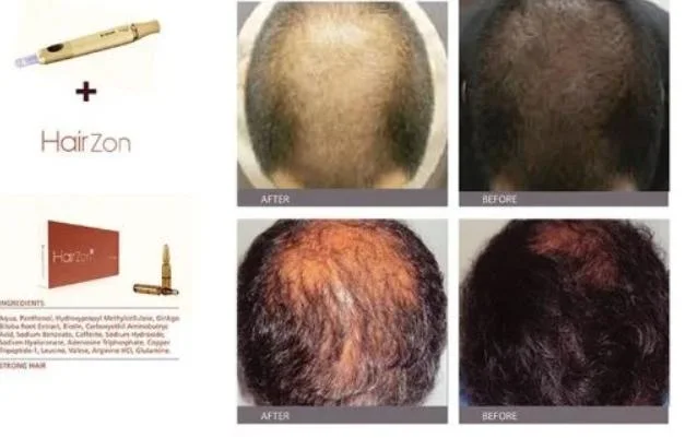 La croissance des cheveux marque Hairzon Dermica 2ml* 10 ampères Améliorer la circulation sanguine contre la perte de cheveux d'injection de mésothérapie