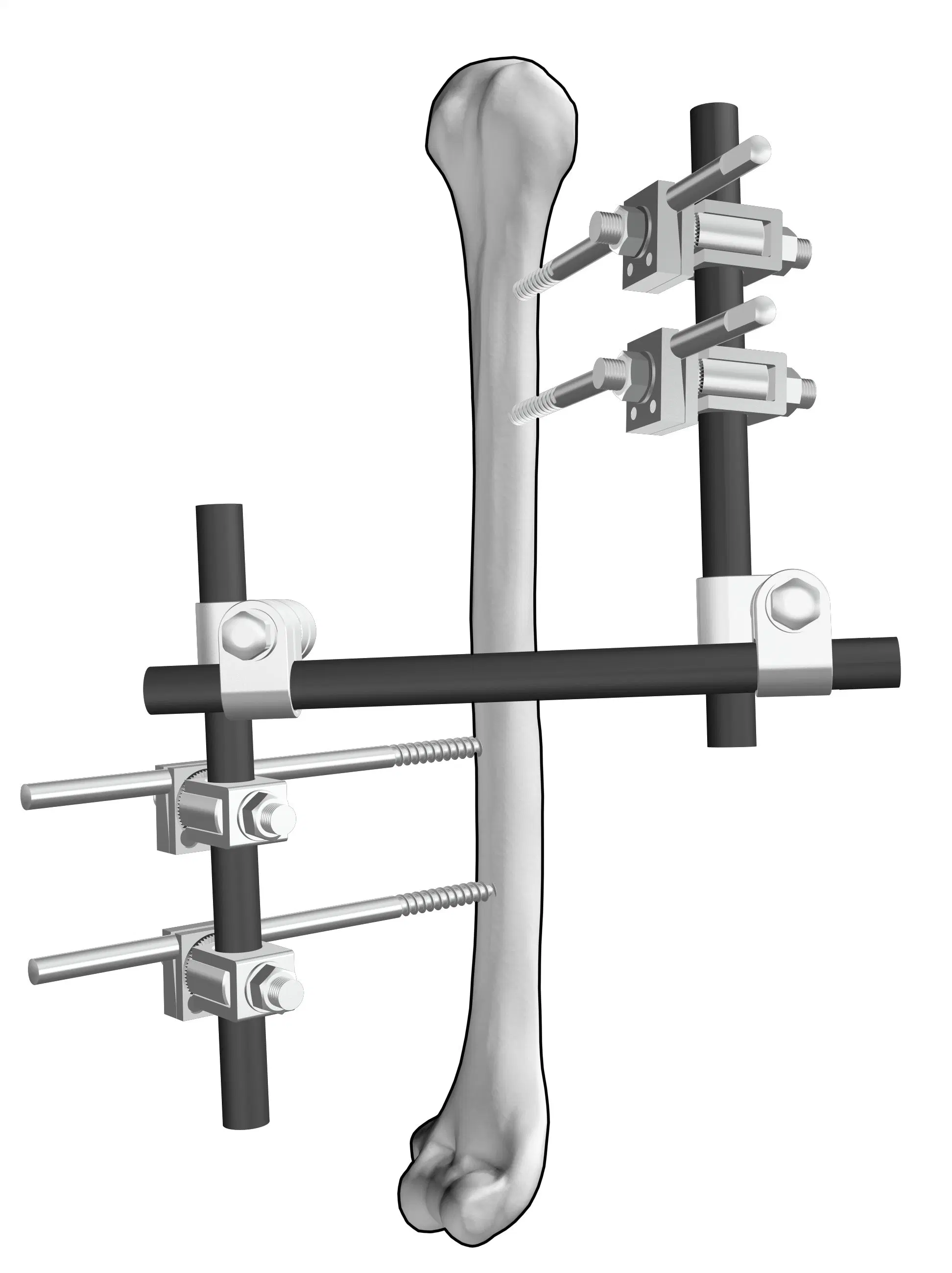 Orthopédie Matériaux d'implants pour traumatismes Instruments chirurgicaux Os Acier inoxydable Équipement Dispositif médical Équipement hospitalier Fourniture Fixation externe pelvienne