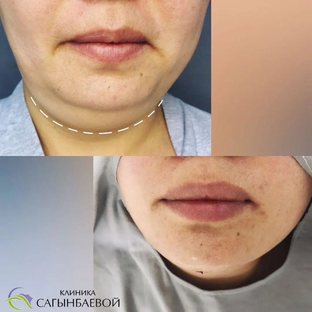 Triangelmed Tragbarer medizinischer Faserlaser Power-Assisted Vaser Liposuction Laser 980nm Plastischer Chirurg Fettentfernung Lipolyse Laser-Gerät 982nm 1470nm