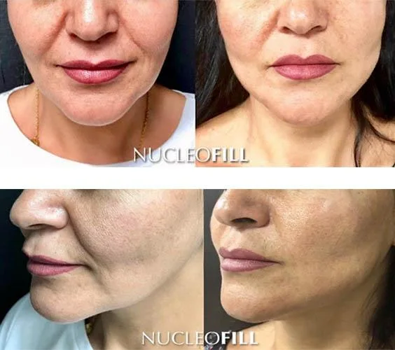 Nucleofill or Profhilo Treatment Nucleofill Strong for Under Eyes Anti Aging Cheek Efekty Zabieg Opinie Nucleofill Soft Eyes Mesotherapy