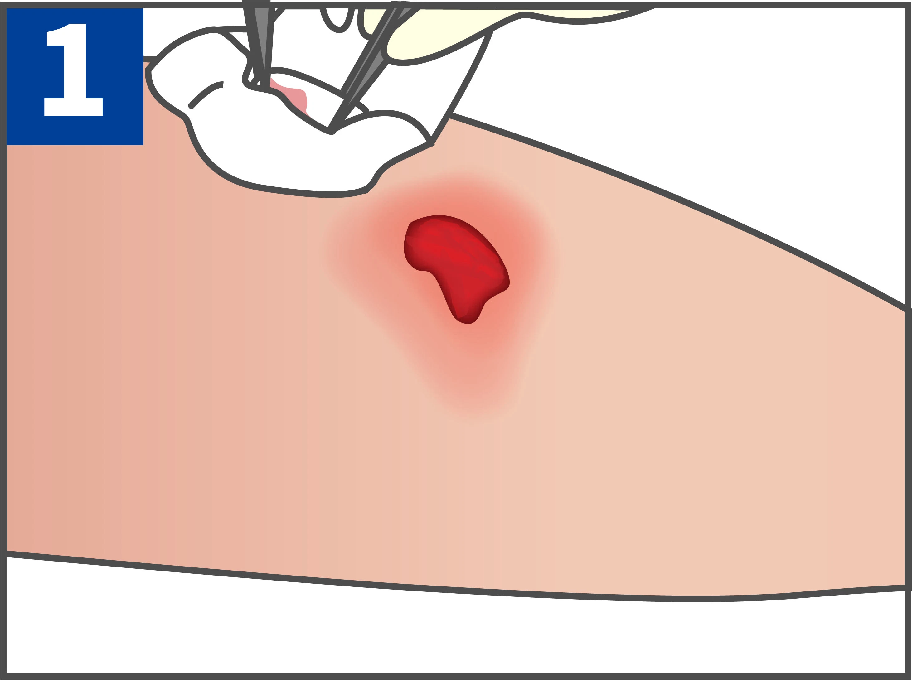 Disposable Medical Sterile Dressing with Low Dressing Change Injury