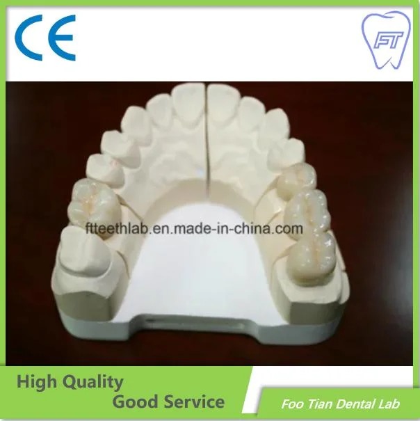 Tratamento odontológico Dental Coroa de cerâmica feitos de metal em Foo Tian Laboratório Dental Shenzhen China